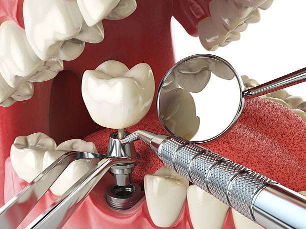 Best Dental Abscess Treatment in Republic, MO